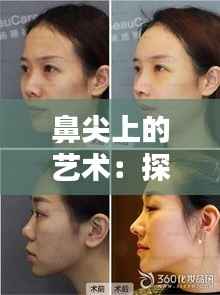 鼻尖上的艺术:探索最新隆鼻术的奇迹
